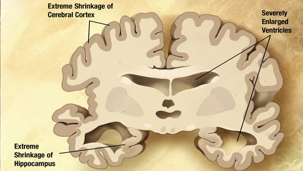 wxrjpgtf3g432oz2e57rj22i5 dementie hersenen