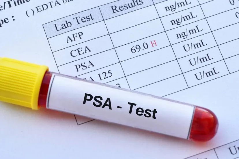 abnormal high psa test result with blood sample tube