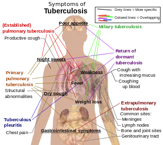 330px tuberculosis symptomssvg