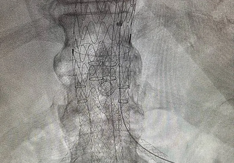 stent-vaatchirurgie-WEB