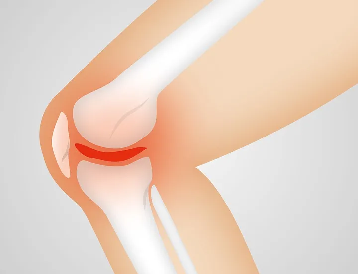 artrose knie naturwohl gesundheid pixabay