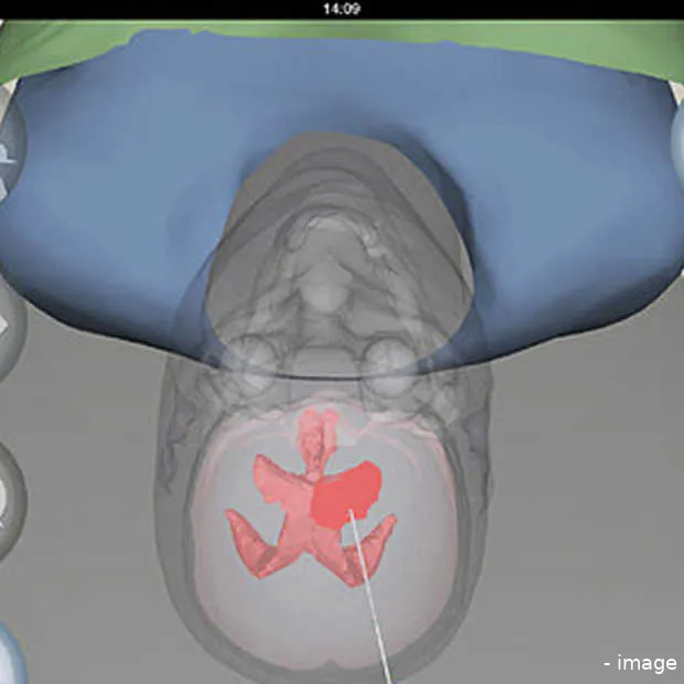 gratis ipad app helpt neurochirurgen met