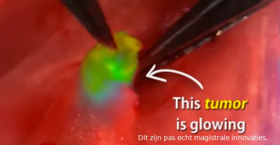 glowtumor