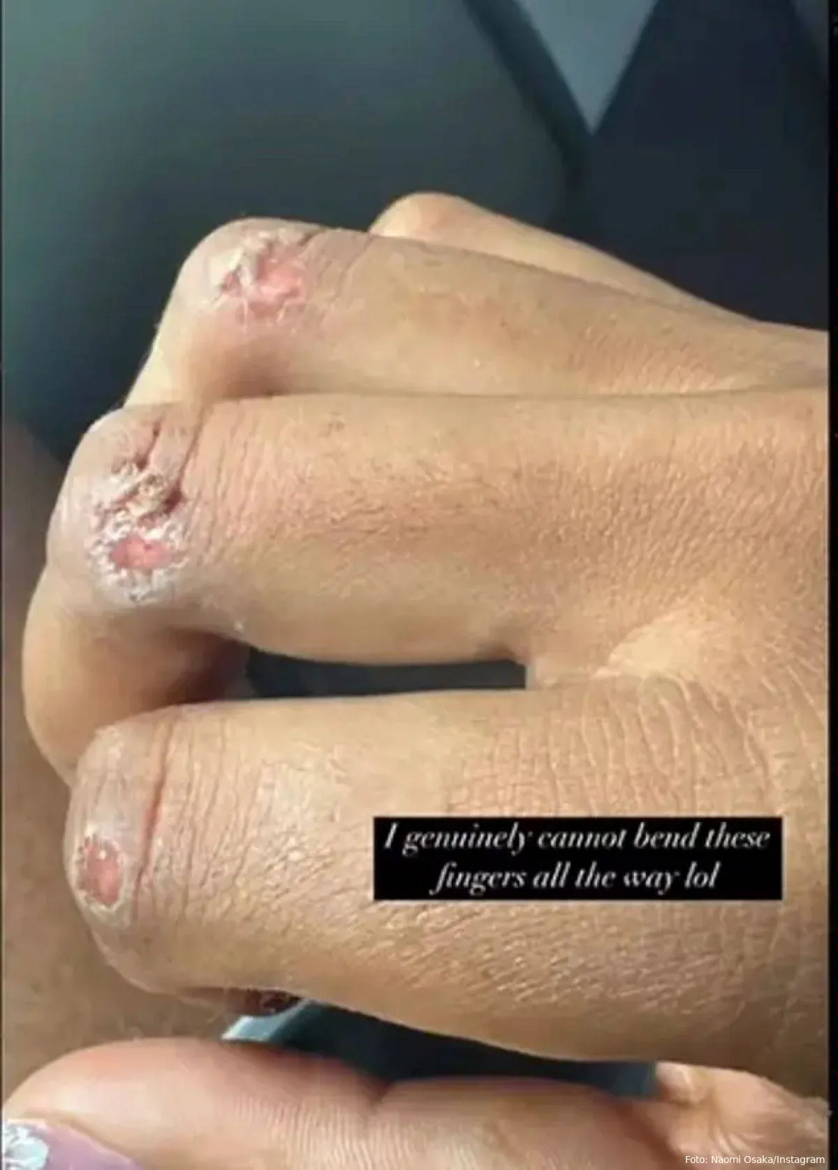 naomi osaka reveals gruesome injury 105536753