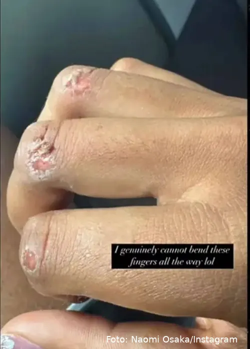 naomi osaka reveals gruesome injury 105536753