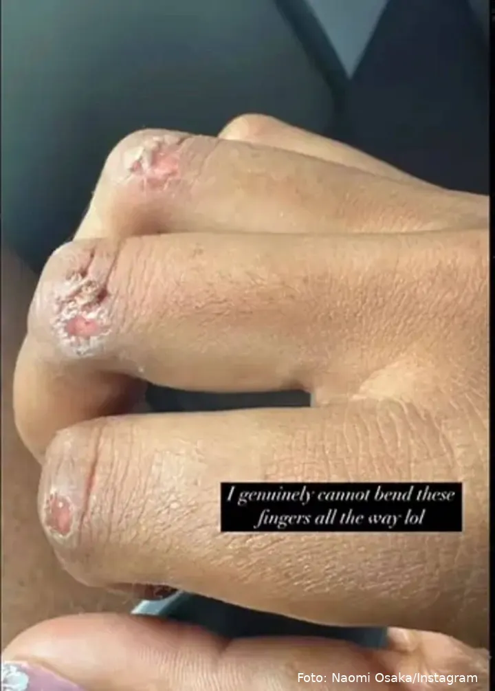 naomi osaka reveals gruesome injury 105536753