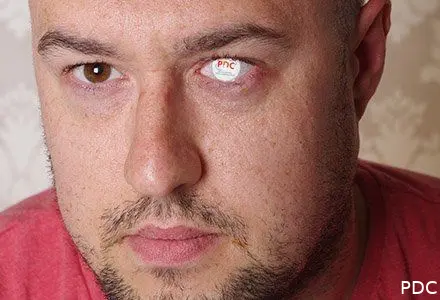 pdc eye