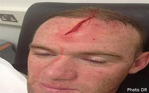 photo rooney montre sa tete pour justifier son forfait wayne rooney 2661582b64901