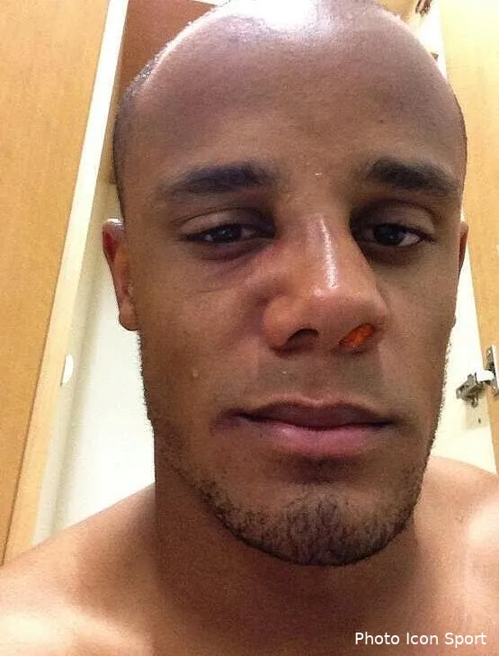 photo kompany joue avec le nez casse et un orbite fissure bmmgd0gccaazfsj59037