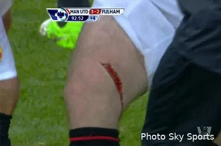 photo l effrayante blessure qui va eloigner rooney pendant un mois 515759 rooney 238979