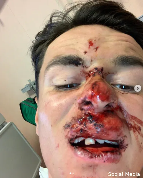 De schade na Pidcock's valpartij in de Ronde van de Toekomst was niet min.