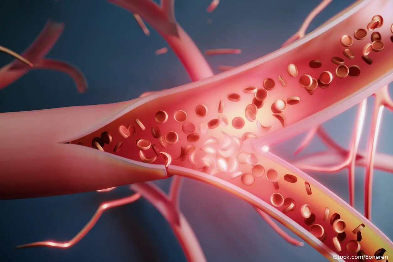 Sickle Cell Disease RBC