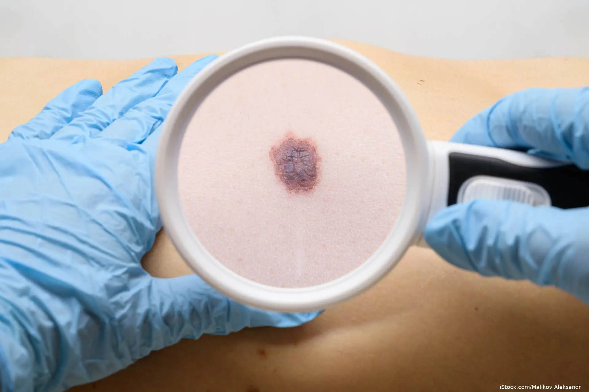 melanoma being viewed through magnifying glass