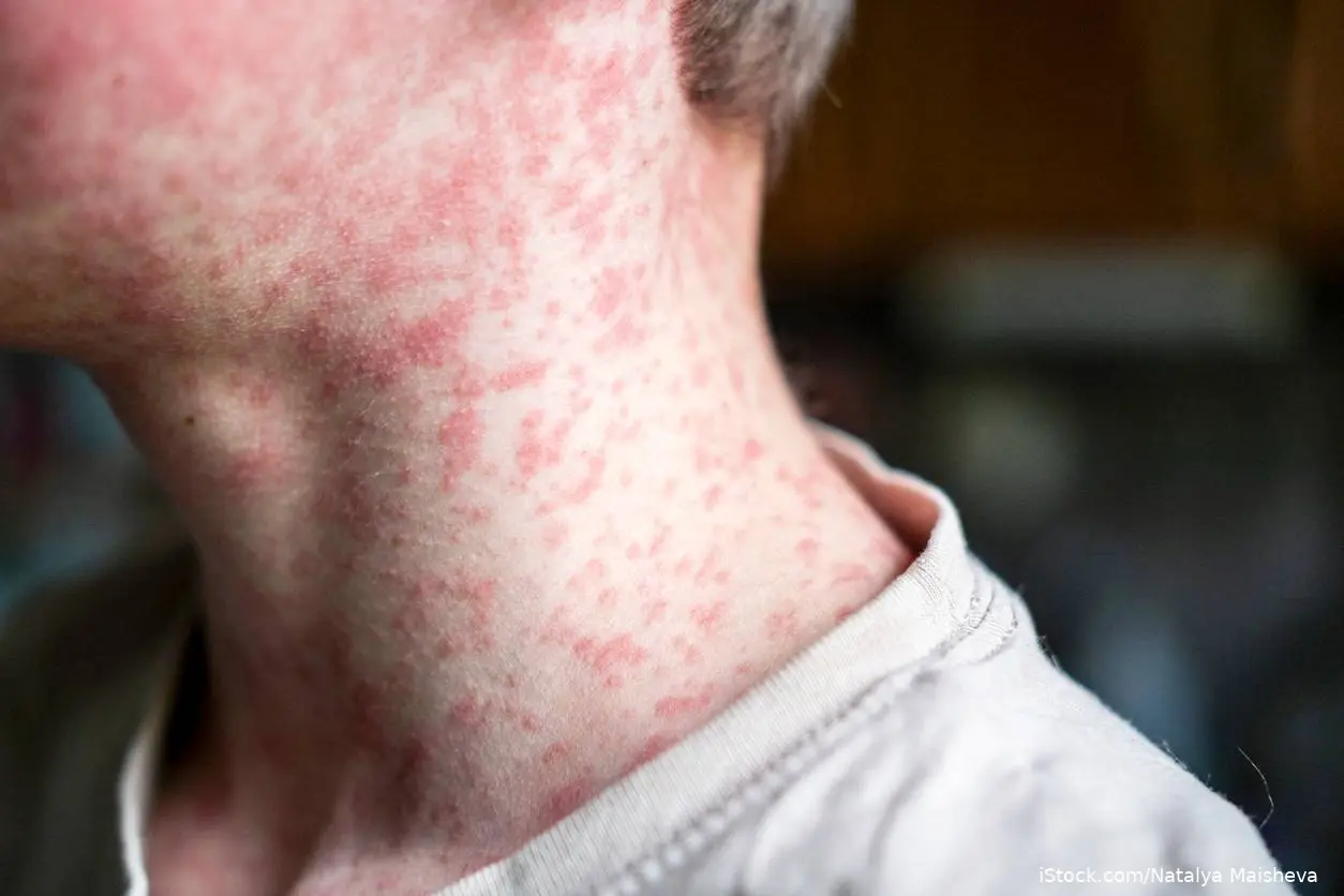 Measles on neck lower face and neck