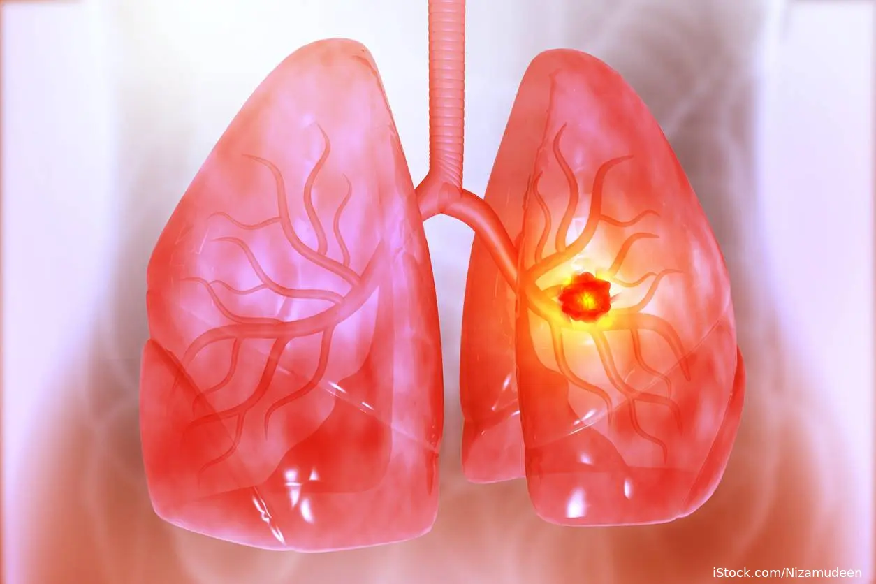 Artist's illustration of lung cancer
