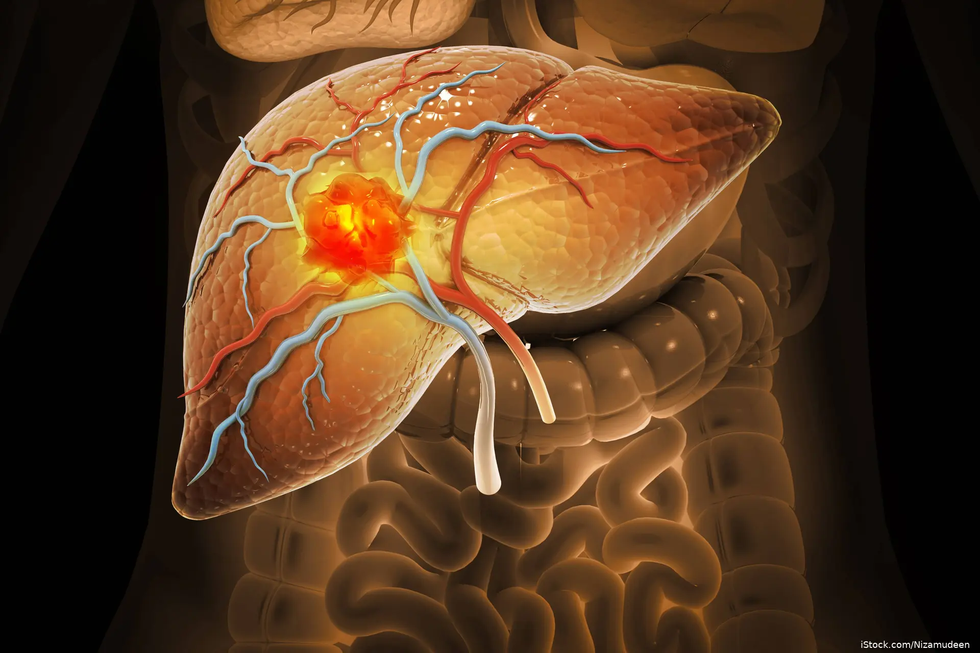 Artist image of liver cancer