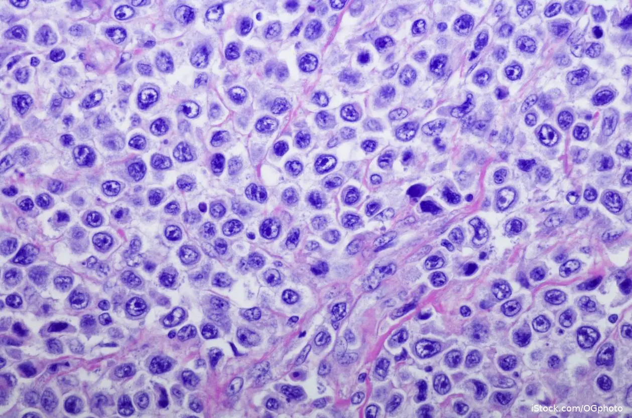 B Cell Lymphoma iStock-870842634