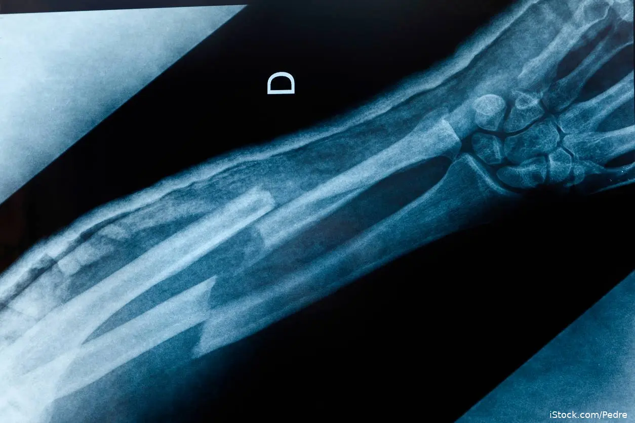 Fractured arm X-ray  iStock-168533336