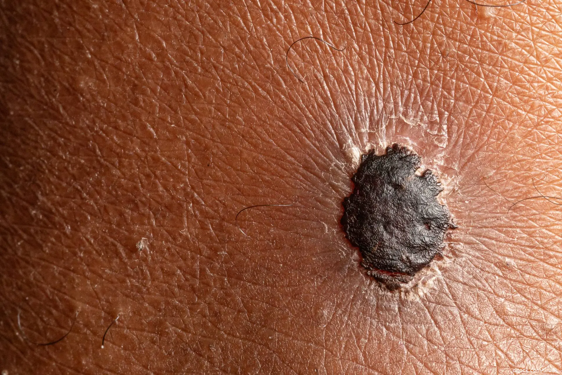 melanoma iStock-2188319167