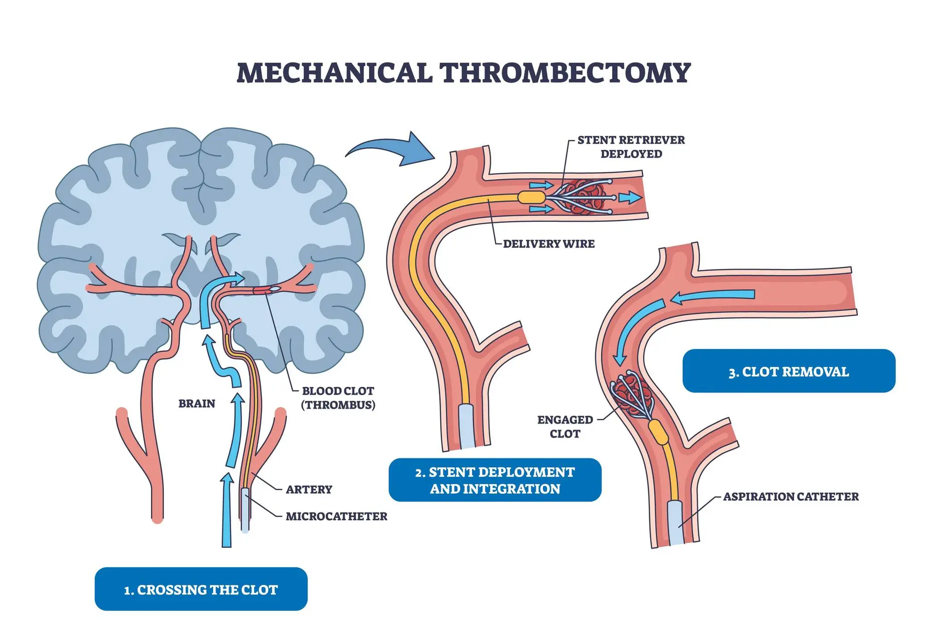 diagram of brain and mechanical thrombectomy