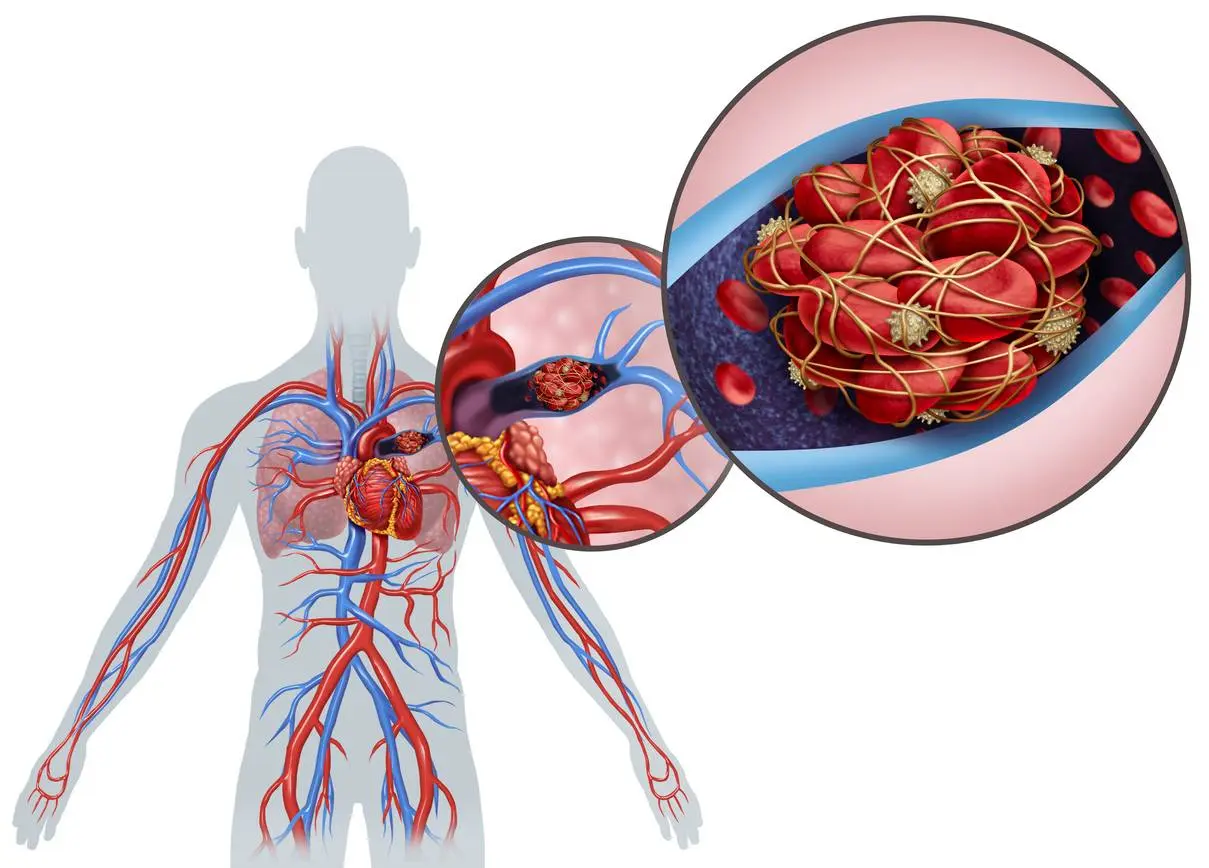Pulmonary Embolism
