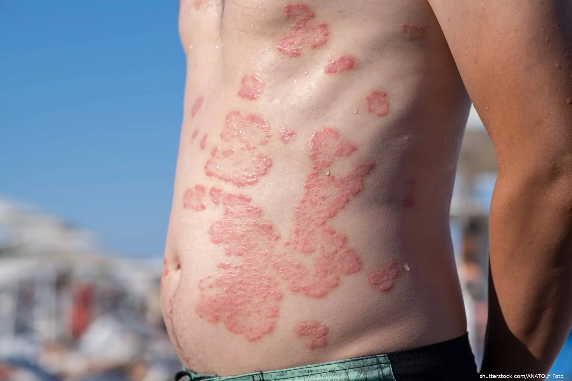 Photo of a male abdomen with Plaque psoriasis