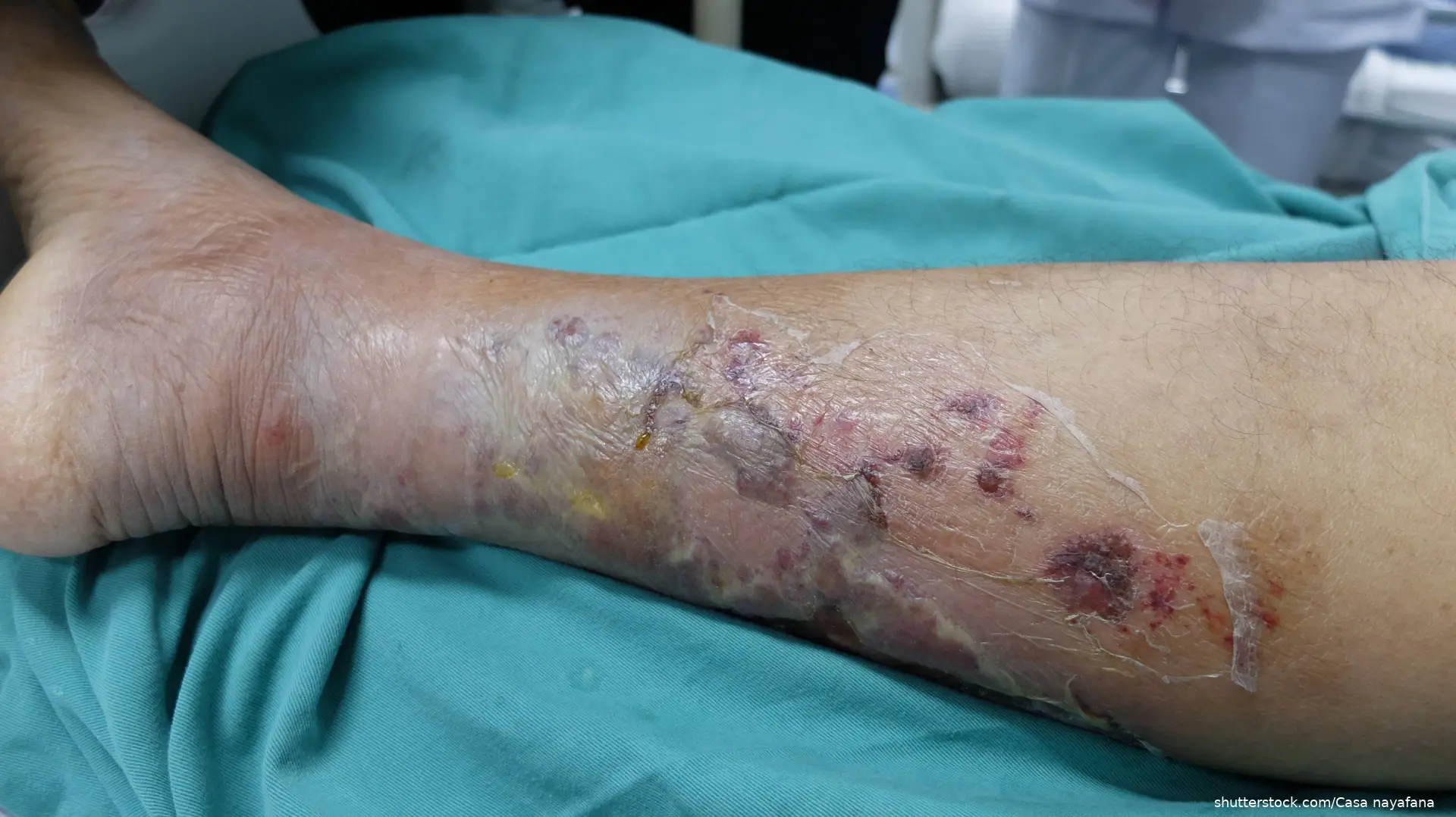 cellulitis on leg