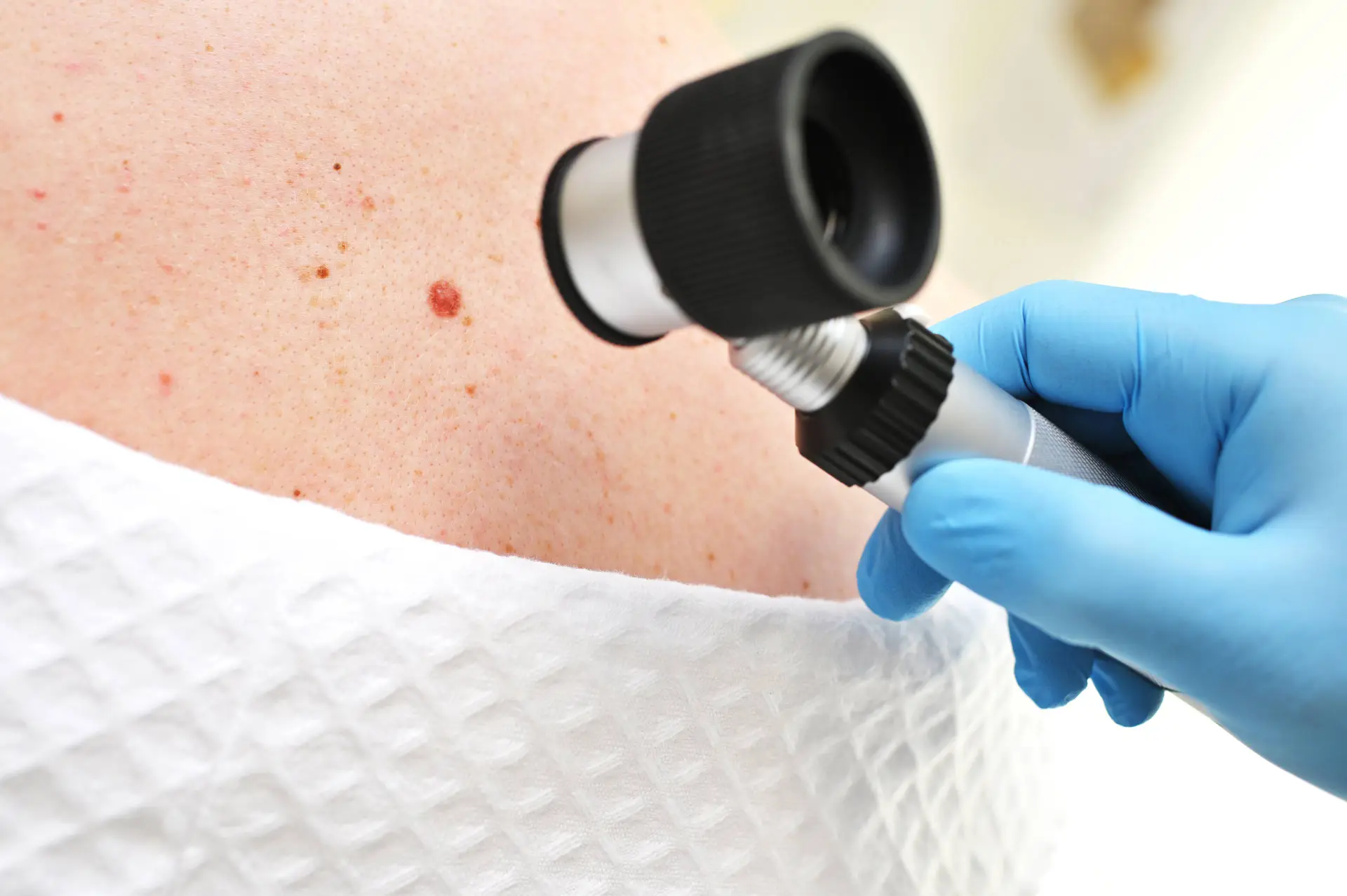 dermatologist oncologist uses a dermatoscope