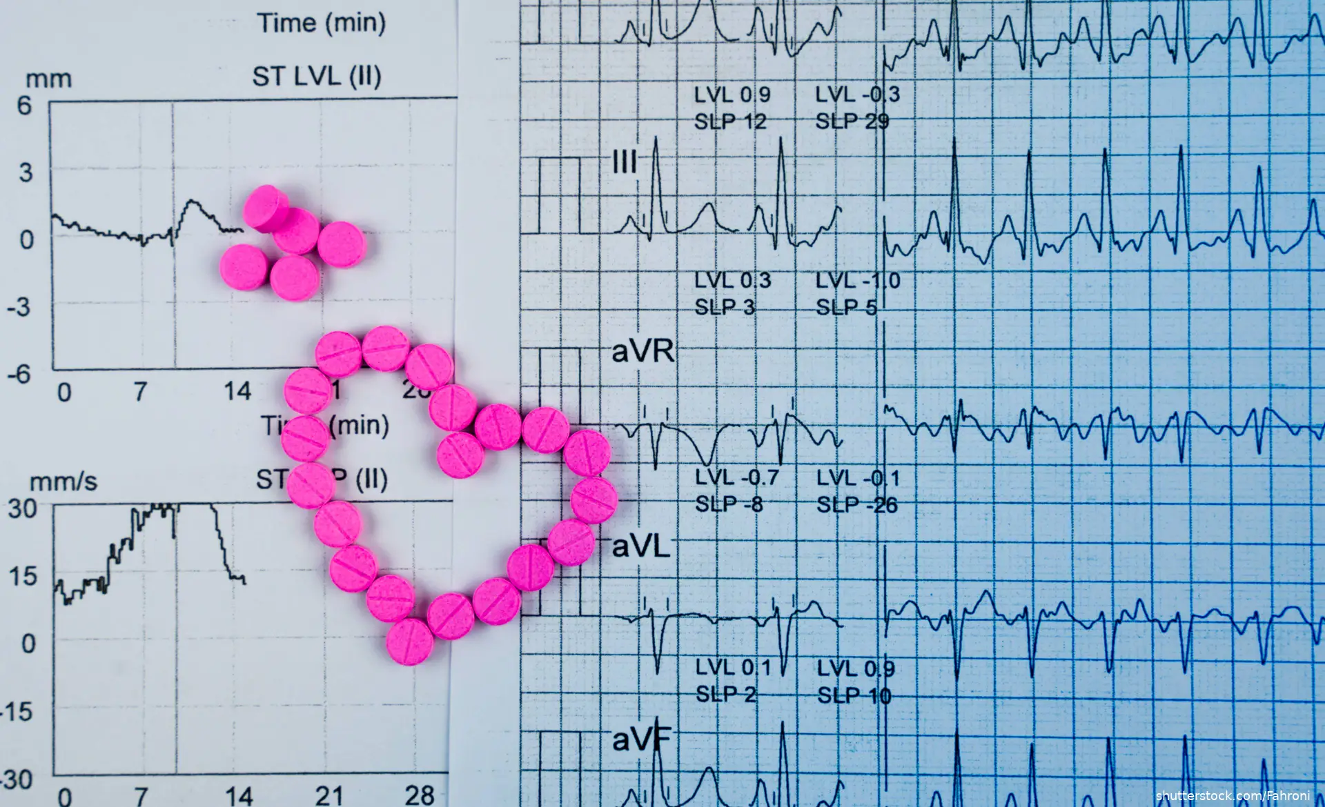 ECG (Electrocardiogram) graph report paper