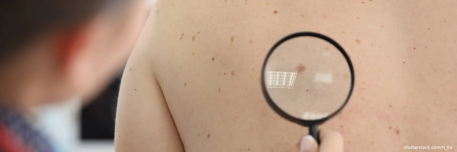 doctor examining melanoma on woman back with magnifying glass