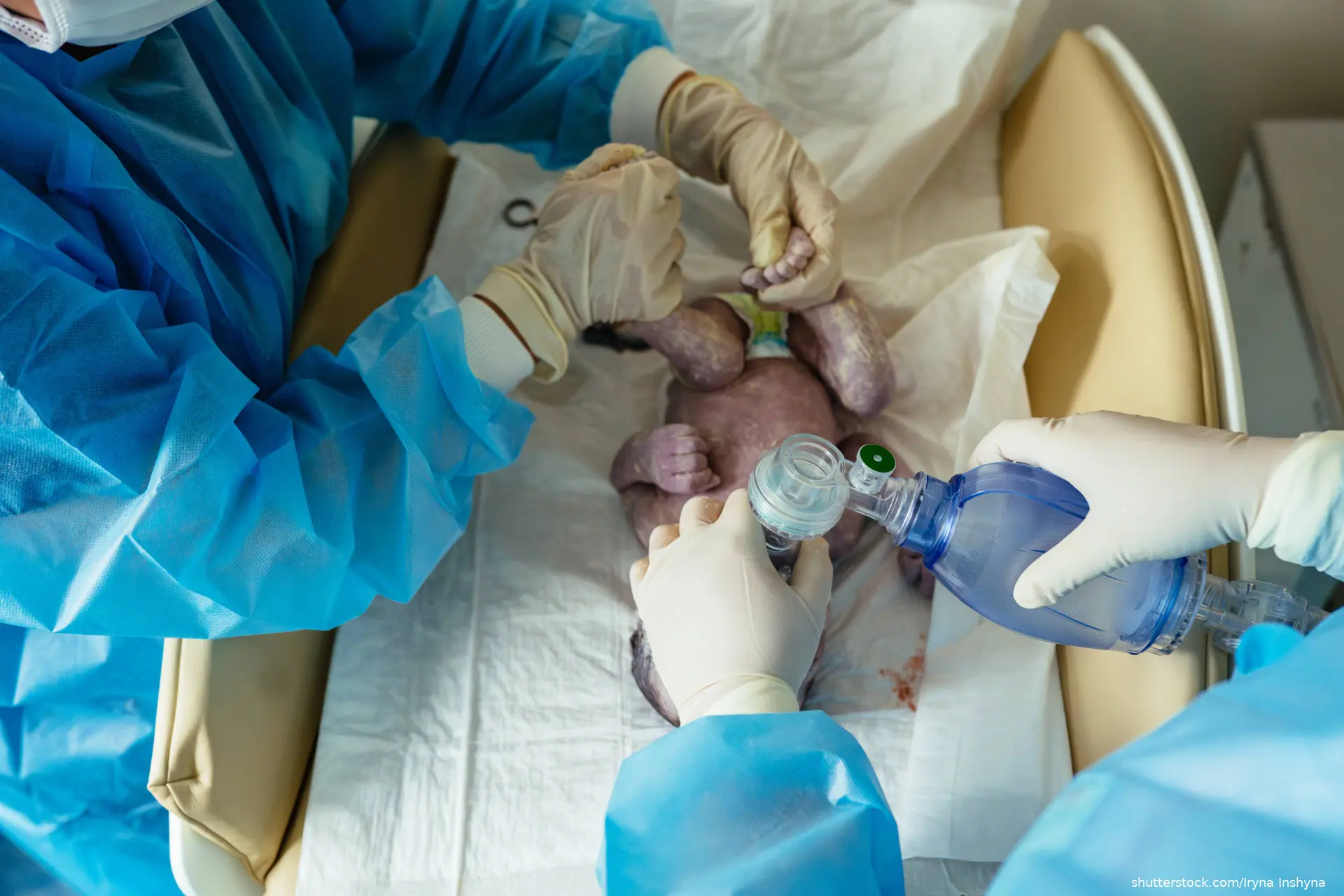 Newborn recieving oxygen