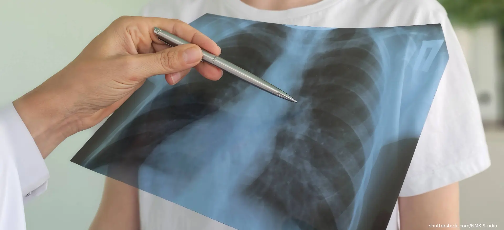 lung xray image shutterstock_2731085103