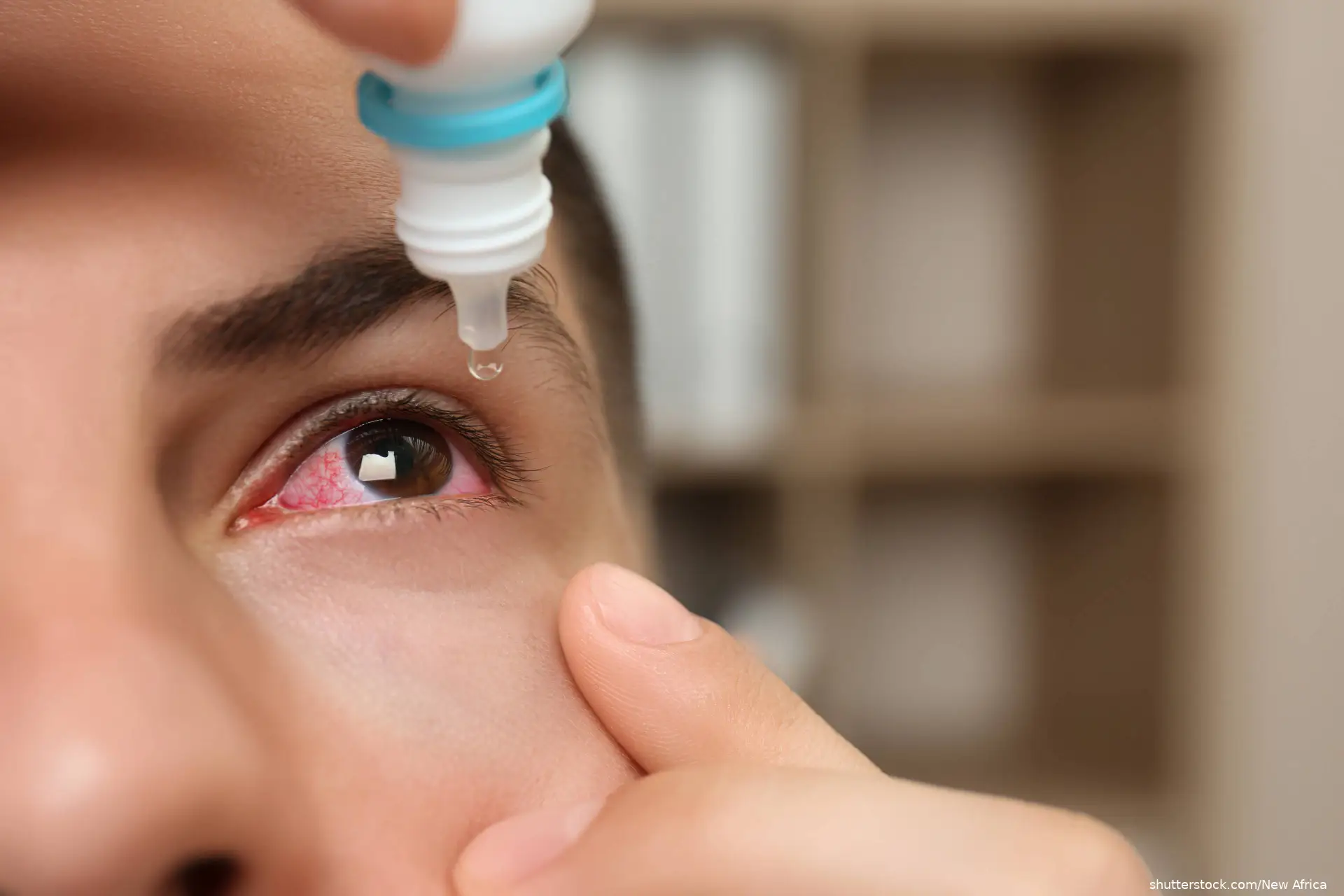Man using eye drops in red eye