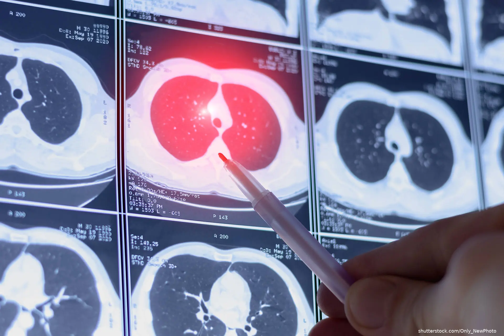 doctor reviewing lung imaging shutterstock_2560898377