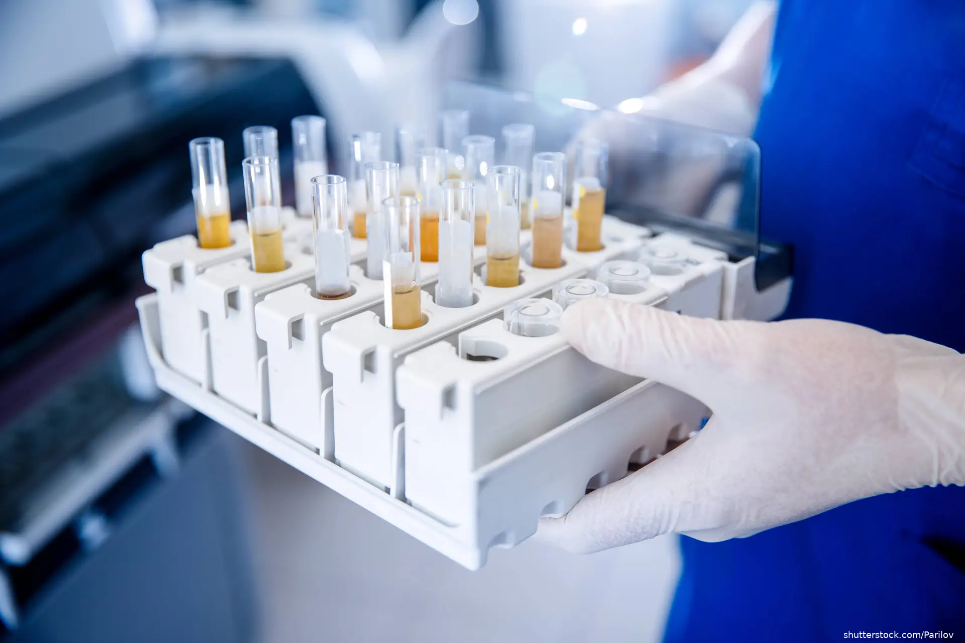 analysis of human urine in medical laboratory