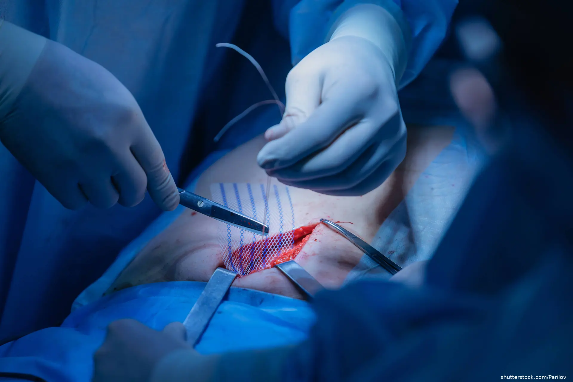 doctor performing surgery with mesh