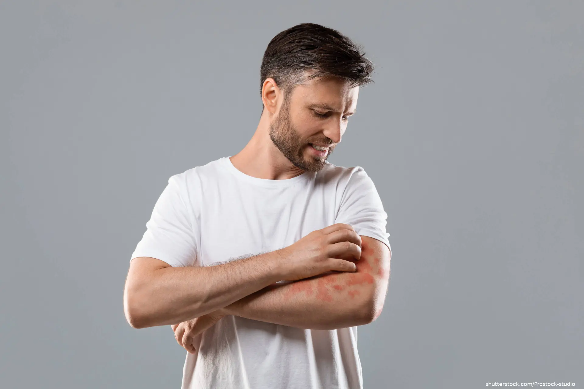 man scratching skin rash on arm