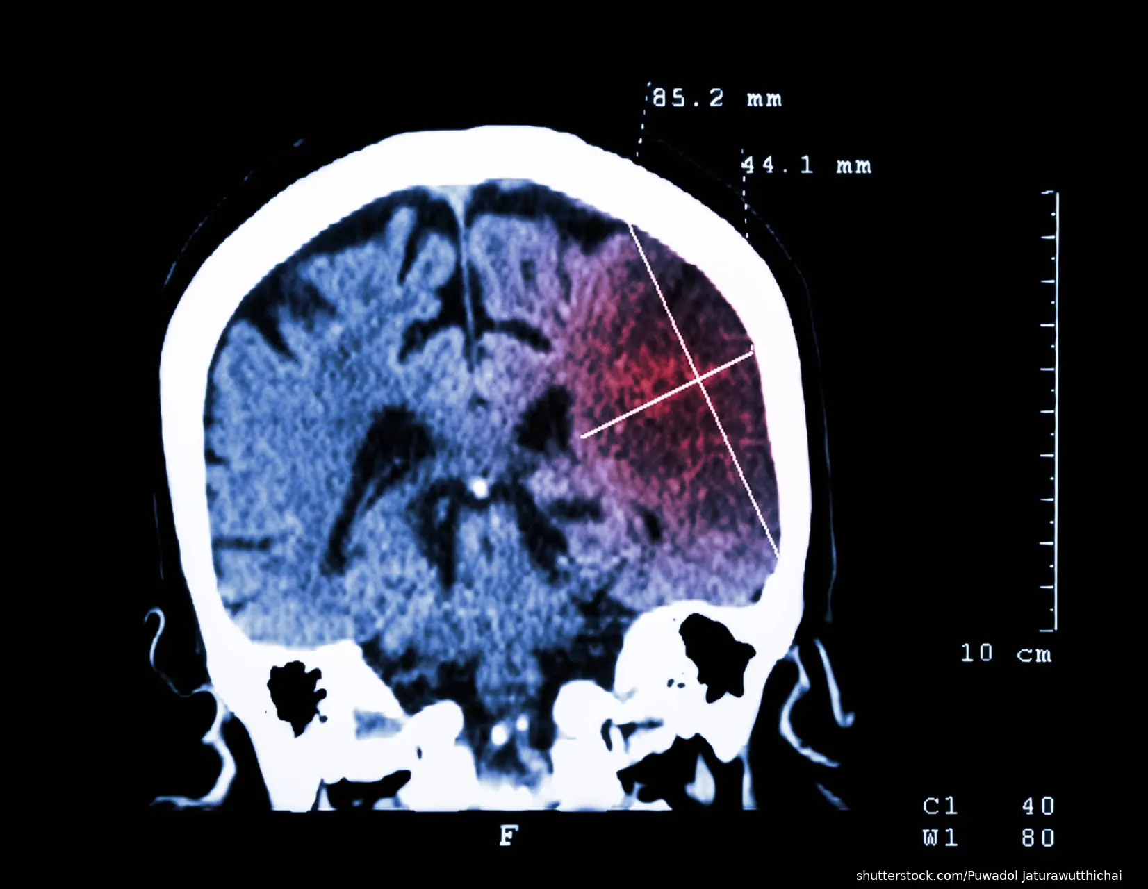 brian image demonstrating Ischemic stroke
