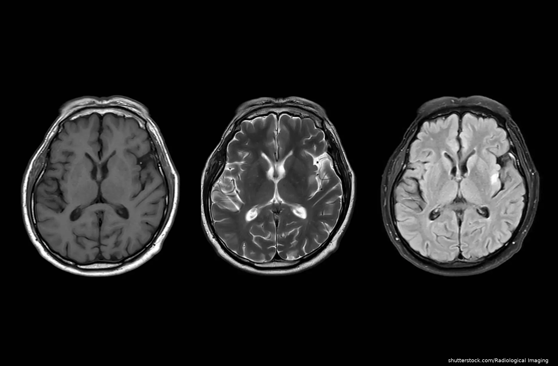 brain scan image