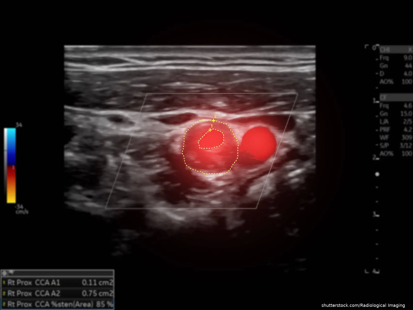 Color Doppler ultrasound study of the carotid artery showing evidence of stenosis