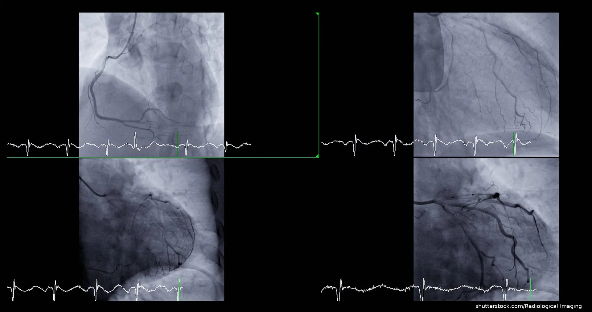 coronary angiography image