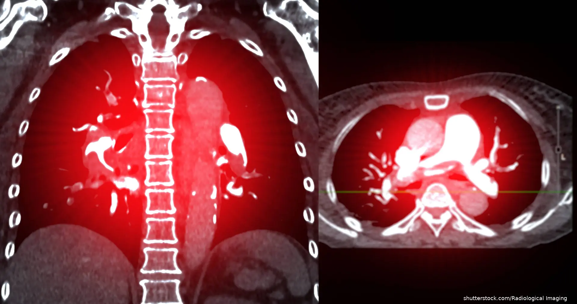 CTA pulmonary artery reveals a detailed view of the lung blood vessels