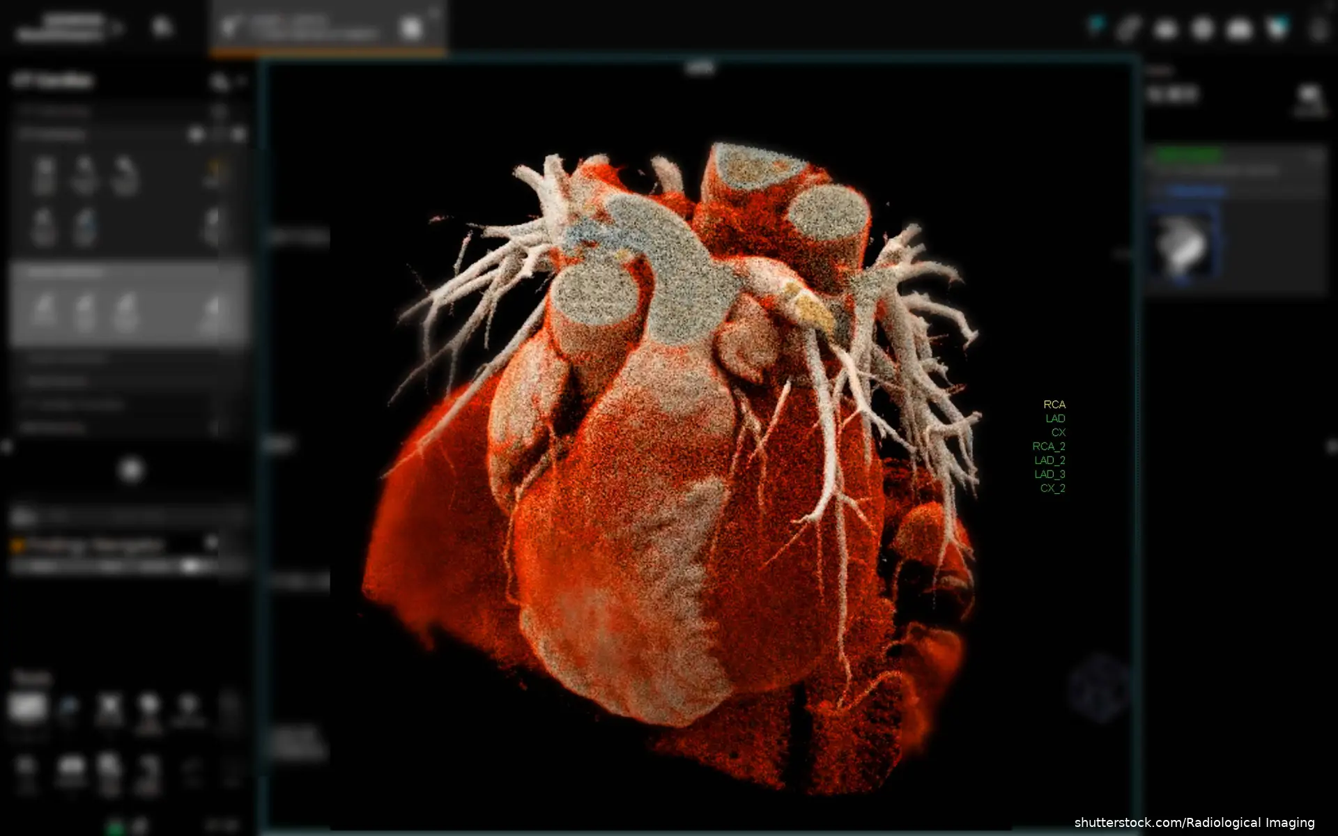 Heart CTA Scan