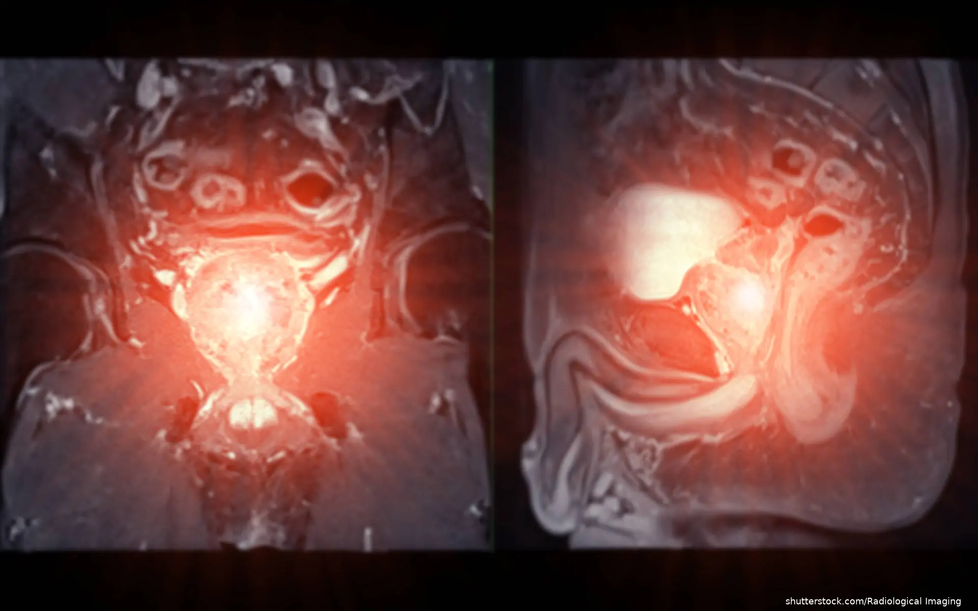 prostate MRI image