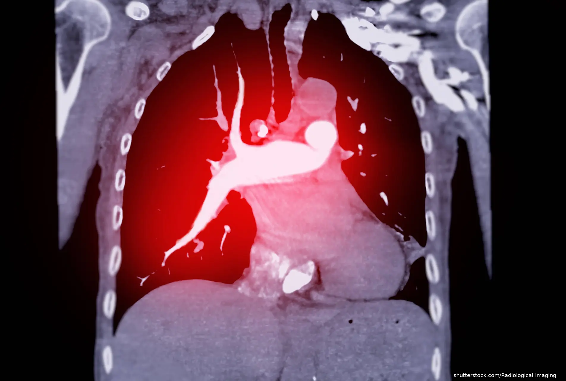 CTA pulmonary artery for diagnostic Pulmonary embolism (PE)