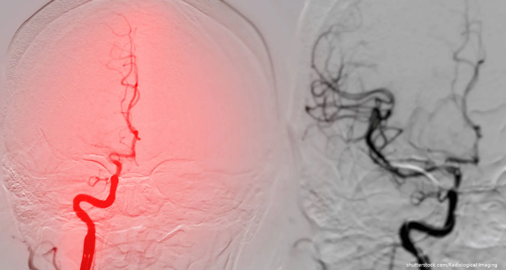 cerebral angiogram image