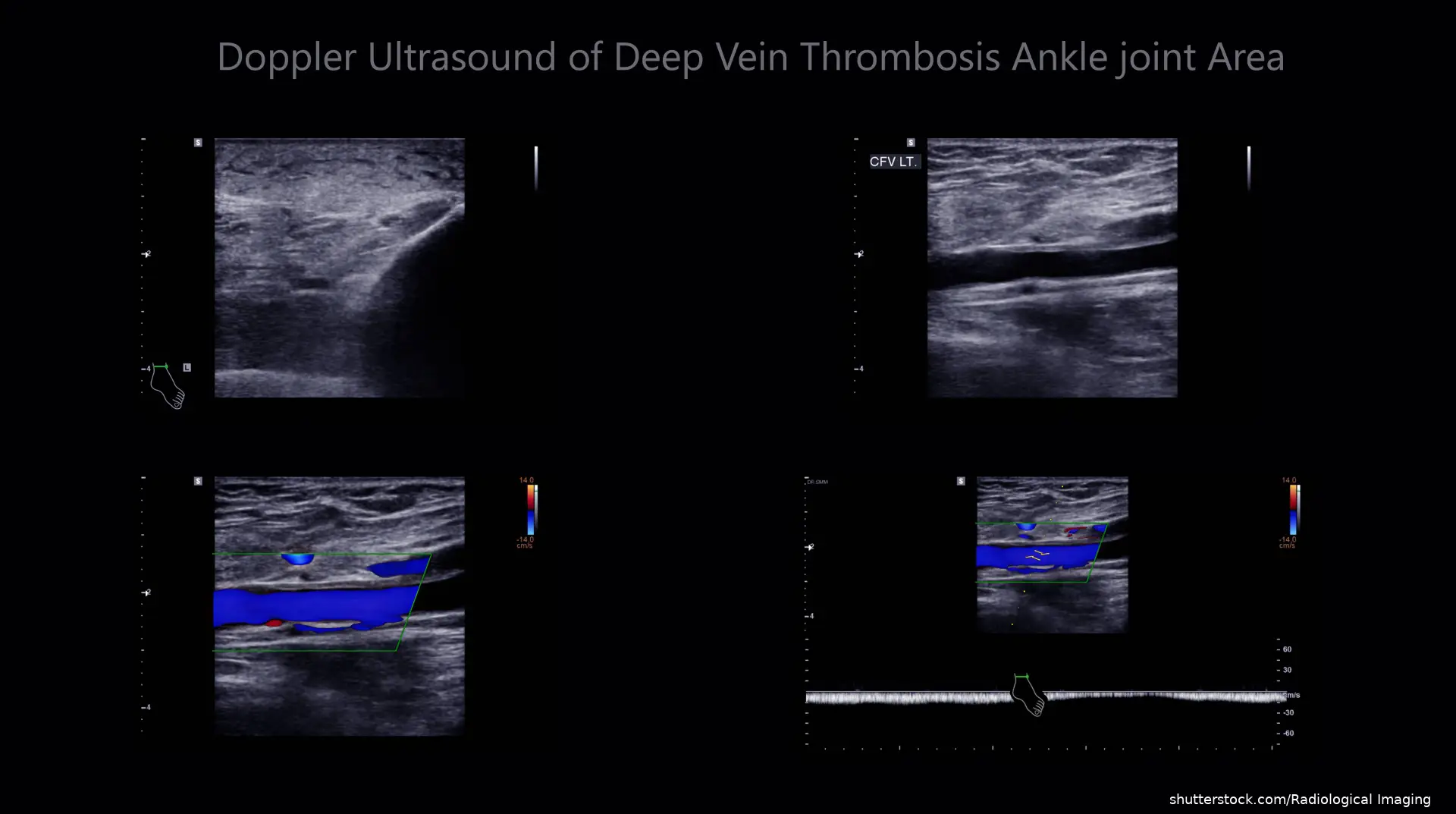 Color Doppler ultrasound determination in deep vein thrombosis