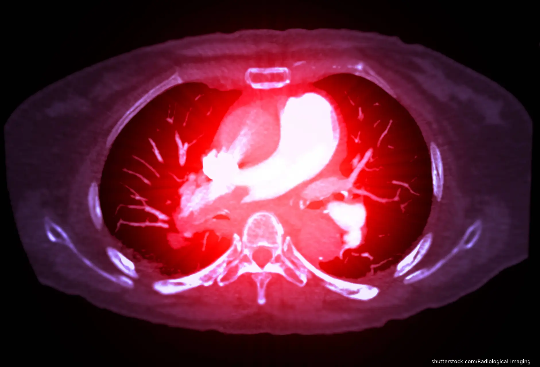 CT scan detailed view of the lung blood vessels