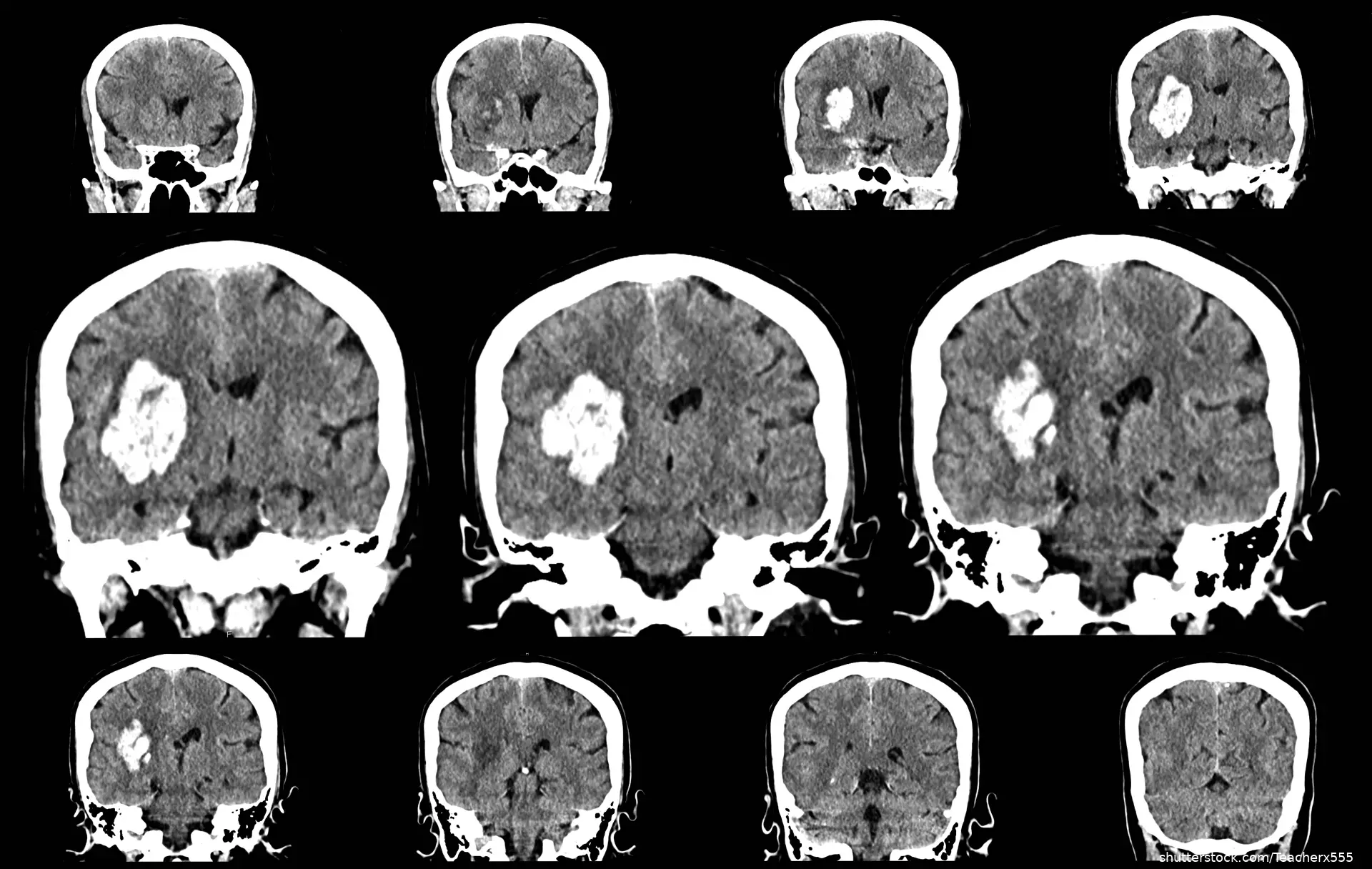 CT scan of brain showing stroke