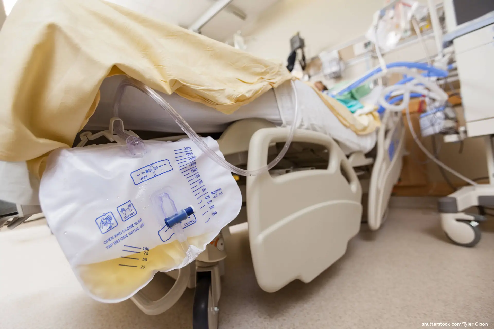Closeup of urine bag attached to bed in hospital